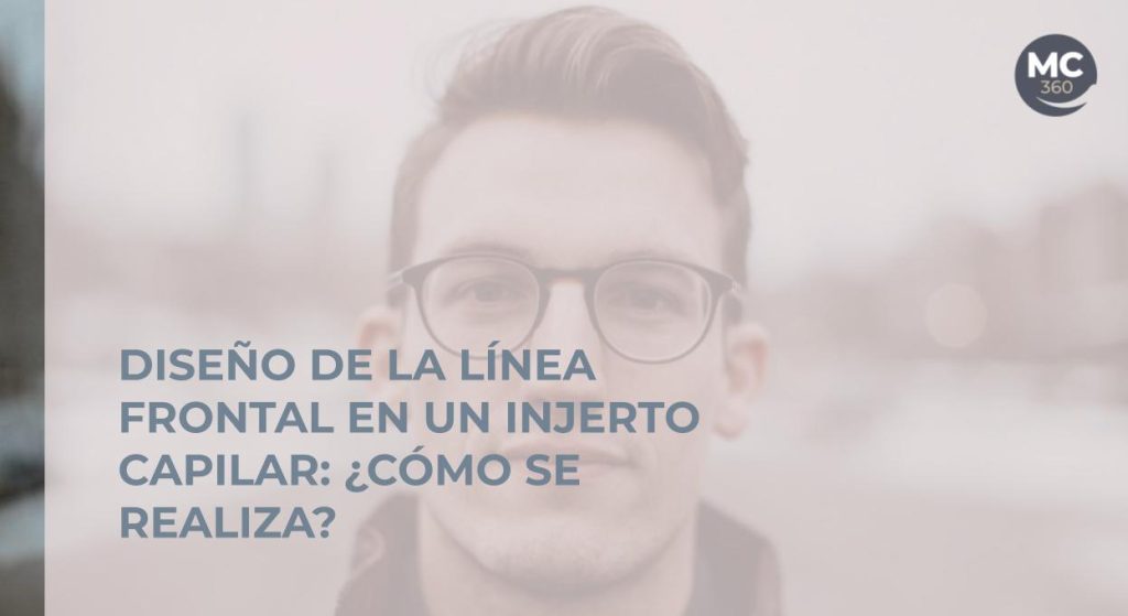 Diseño línea frontal injerto capilar